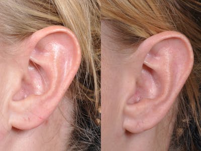 Earlobe Repair Before & After Gallery - Patient 159070 - Image 2