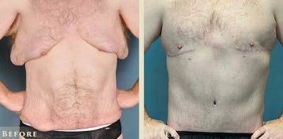Male Liposuction Before & After Gallery - Patient 291491 - Image 1