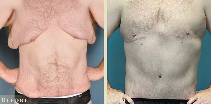 Male Liposuction Before & After Gallery - Patient 291491 - Image 1