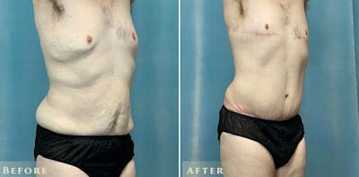 Male Tummy Tuck Before & After Gallery - Patient 970106 - Image 3
