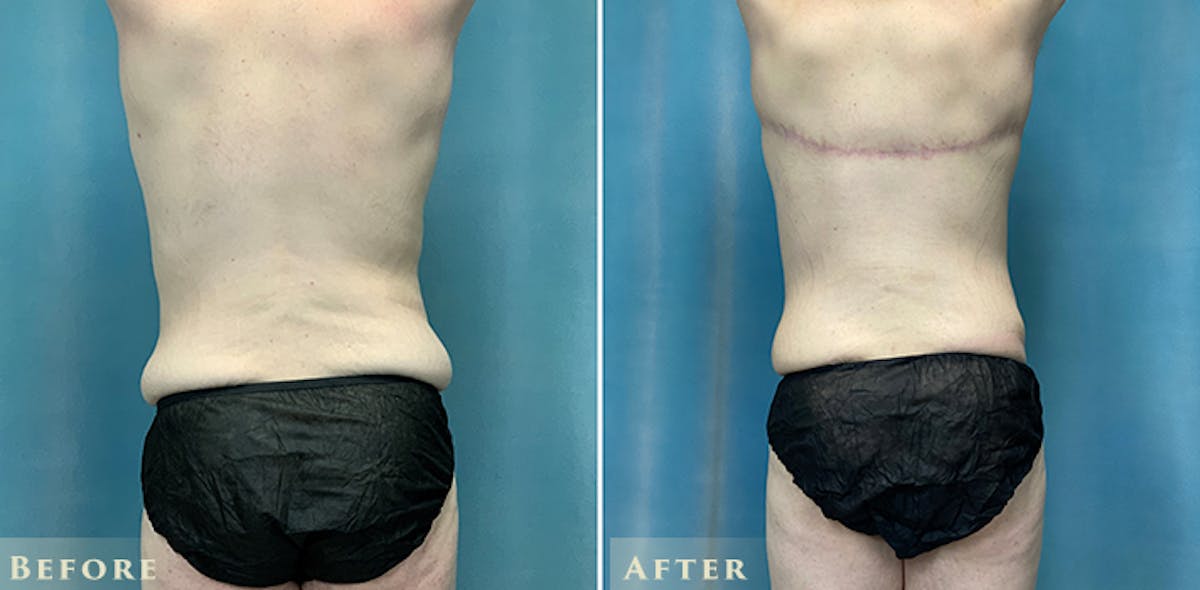 Male Tummy Tuck Before & After Gallery - Patient 970106 - Image 4