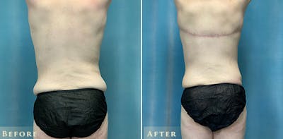 Male Tummy Tuck Before & After Gallery - Patient 970106 - Image 4