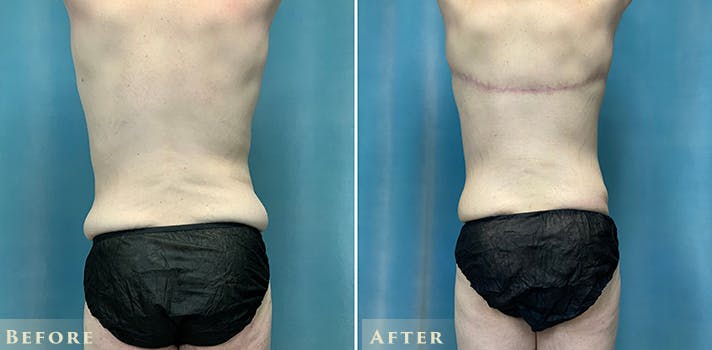 Male Breast Reduction (Gynecomastia) Before & After Gallery - Patient 527424 - Image 4