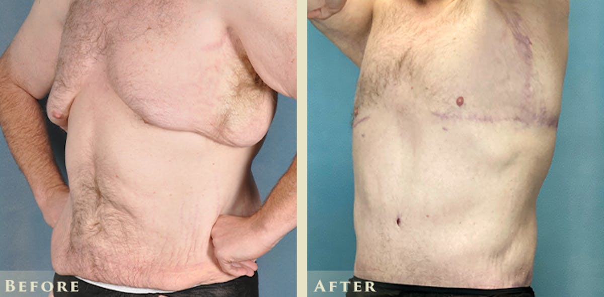 Male Liposuction Before & After Gallery - Patient 291491 - Image 3