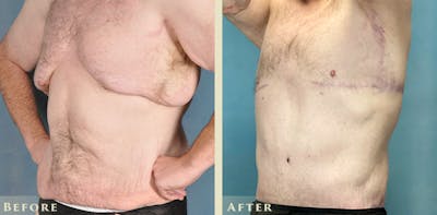 Male Liposuction Before & After Gallery - Patient 291491 - Image 3