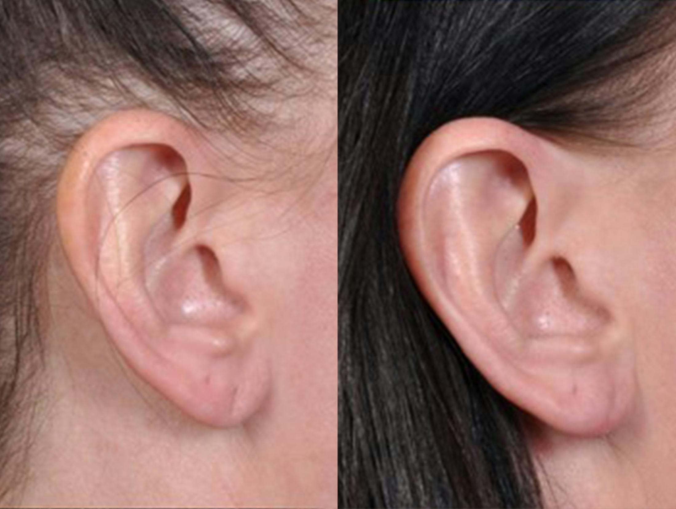Earlobe Repair Before & After Gallery - Patient 342668 - Image 1