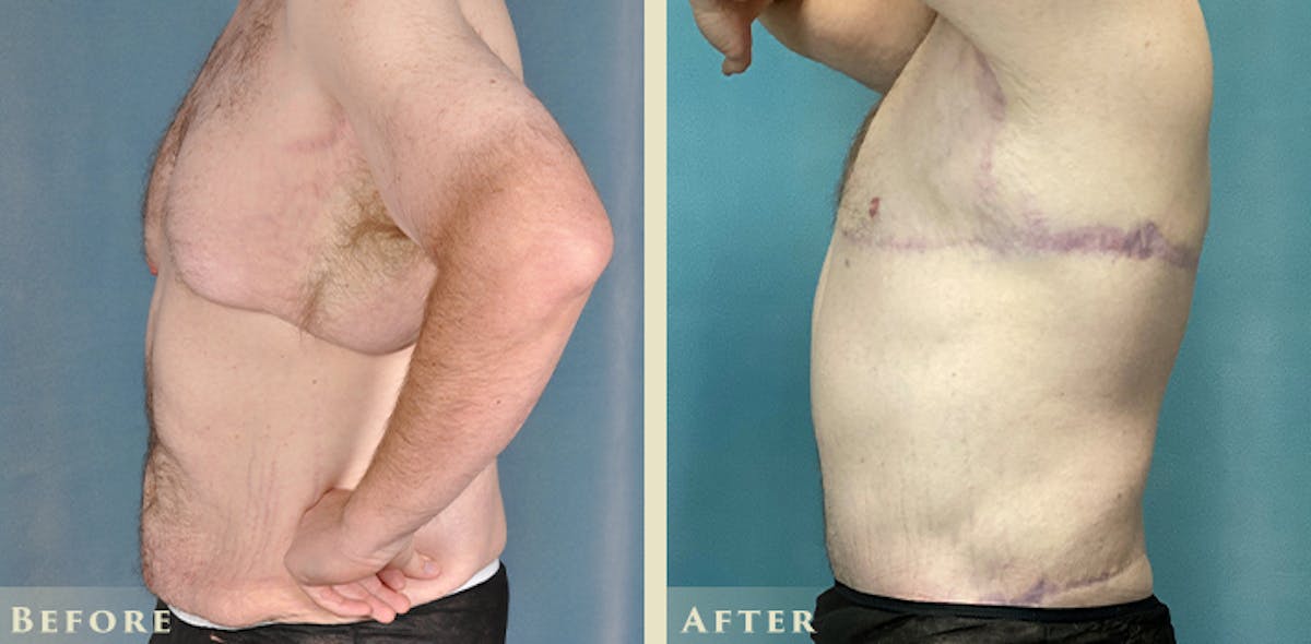 Male Liposuction Before & After Gallery - Patient 291491 - Image 4