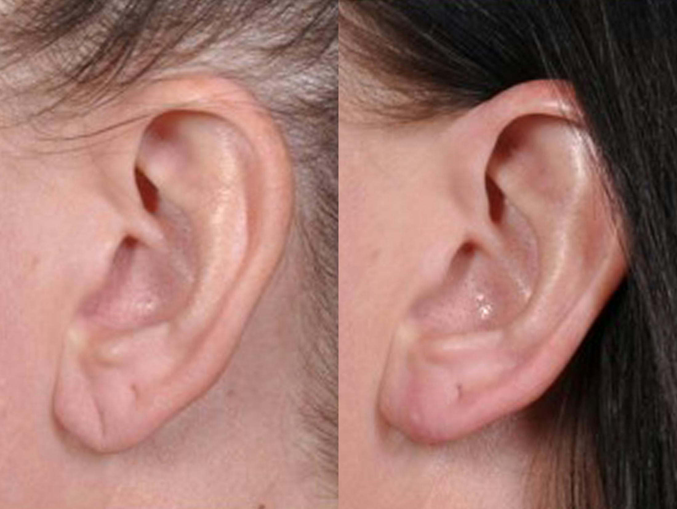 Earlobe Repair Before & After Gallery - Patient 342668 - Image 2