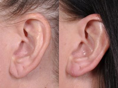 Earlobe Repair Before & After Gallery - Patient 342668 - Image 2