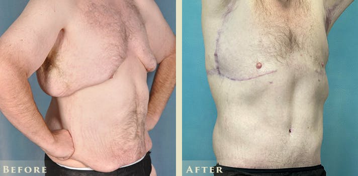 Male Breast Reduction (Gynecomastia) Before & After Gallery - Patient 509710 - Image 2