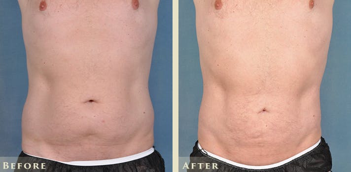 Male Liposuction Before & After Gallery - Patient 254363 - Image 1