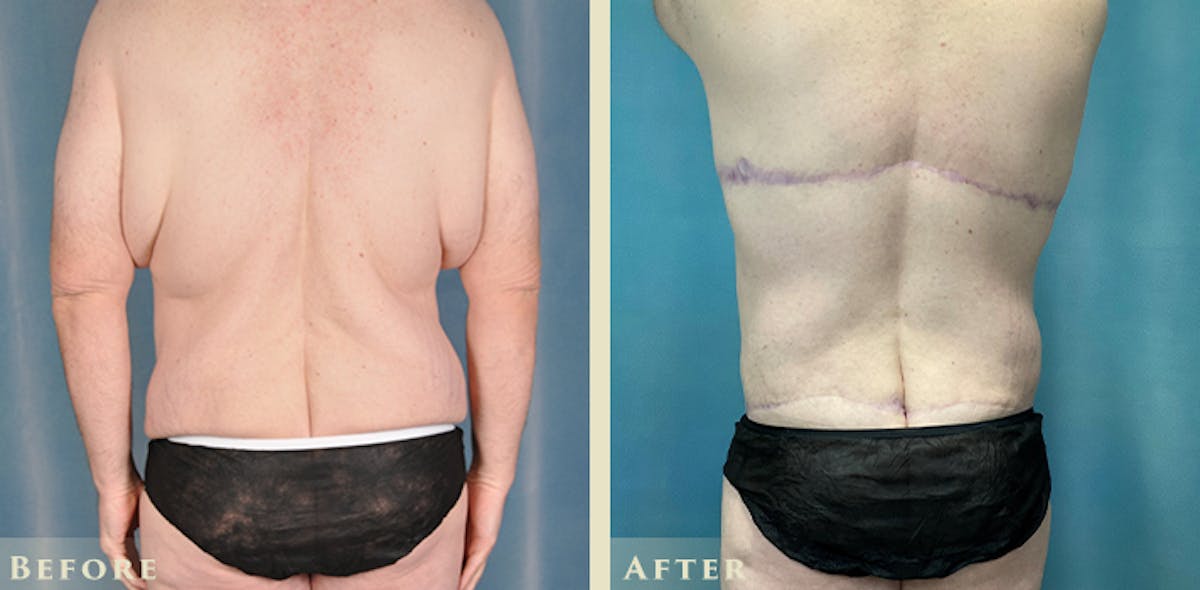 Male Body Lift Before & After Gallery - Patient 401672 - Image 5