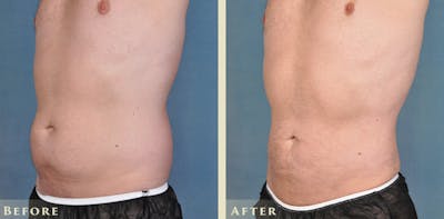 Male Liposuction Before & After Gallery - Patient 254363 - Image 2