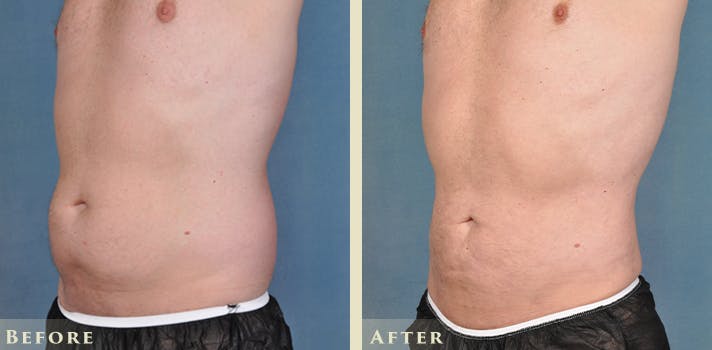 Male Liposuction Before & After Gallery - Patient 254363 - Image 2