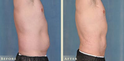 Male Liposuction Before & After Gallery - Patient 254363 - Image 3