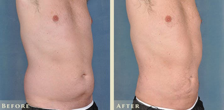 Male Liposuction Before & After Gallery - Patient 254363 - Image 4