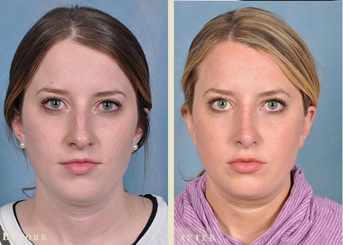 Reconstructive Rhinoplasty Before & After Gallery - Patient 184359 - Image 1