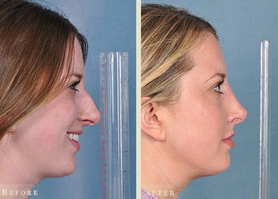 Reconstructive Rhinoplasty Before & After Gallery - Patient 184359 - Image 2