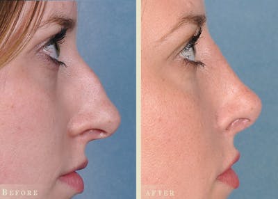 Reconstructive Rhinoplasty Before & After Gallery - Patient 184359 - Image 3