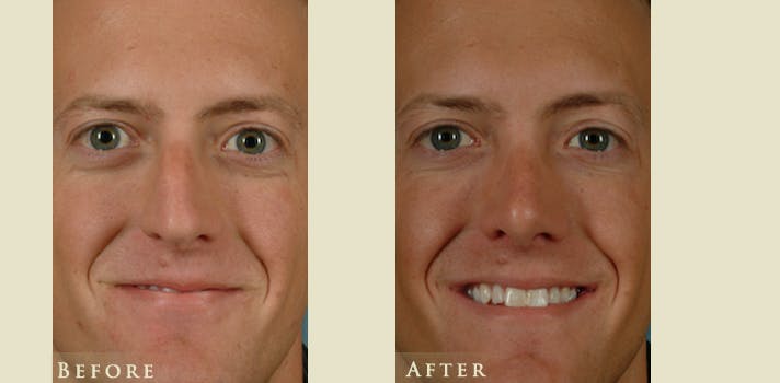 Reconstructive Rhinoplasty Before & After Gallery - Patient 158927 - Image 1