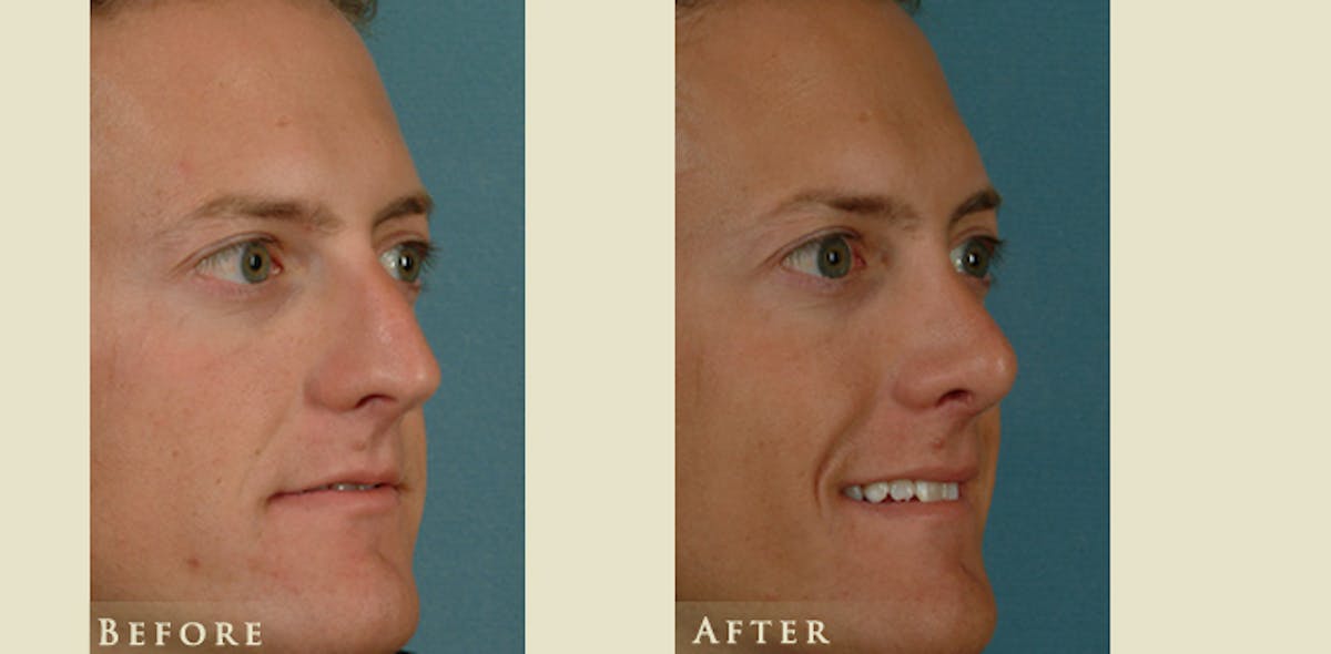 Reconstructive Rhinoplasty Before & After Gallery - Patient 158927 - Image 2