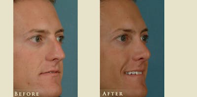 Reconstructive Rhinoplasty Before & After Gallery - Patient 158927 - Image 2