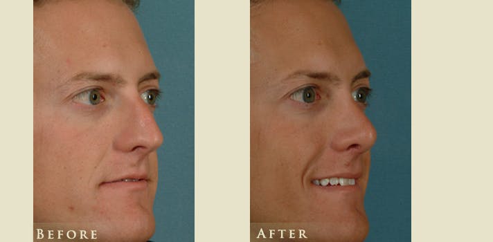 Reconstructive Rhinoplasty Before & After Gallery - Patient 158927 - Image 2