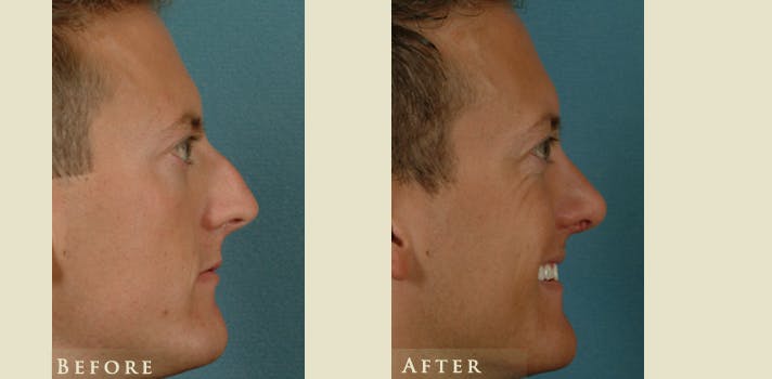 Reconstructive Rhinoplasty Before & After Gallery - Patient 158927 - Image 3