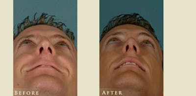 Reconstructive Rhinoplasty Before & After Gallery - Patient 158927 - Image 4
