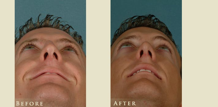Reconstructive Rhinoplasty Before & After Gallery - Patient 158927 - Image 4