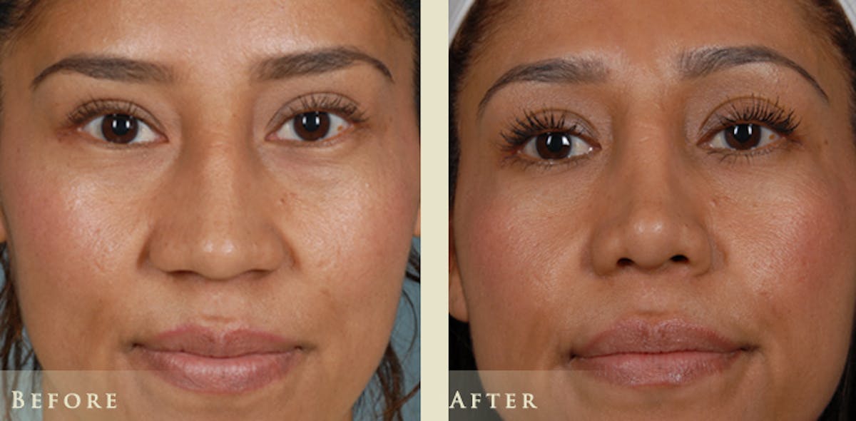 Reconstructive Rhinoplasty Before & After Gallery - Patient 282180 - Image 1