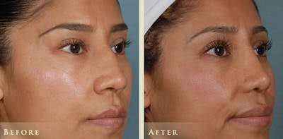 Reconstructive Rhinoplasty Before & After Gallery - Patient 282180 - Image 2