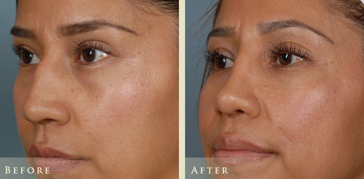 Reconstructive Rhinoplasty Before & After Gallery - Patient 282180 - Image 3