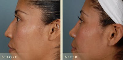 Reconstructive Rhinoplasty Before & After Gallery - Patient 282180 - Image 4