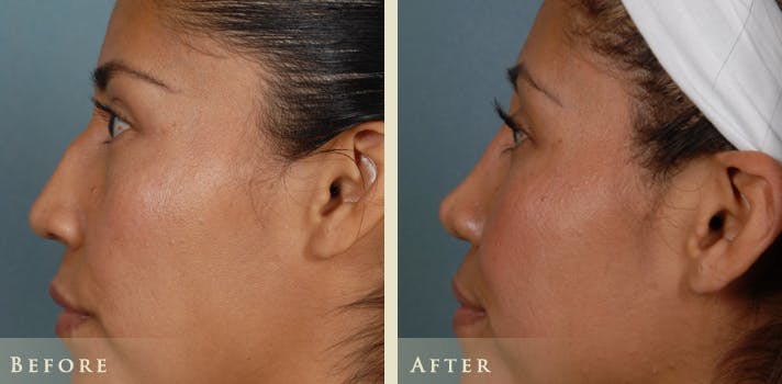 Reconstructive Rhinoplasty Before & After Gallery - Patient 282180 - Image 4