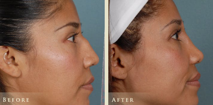 Reconstructive Rhinoplasty Before & After Gallery - Patient 282180 - Image 5