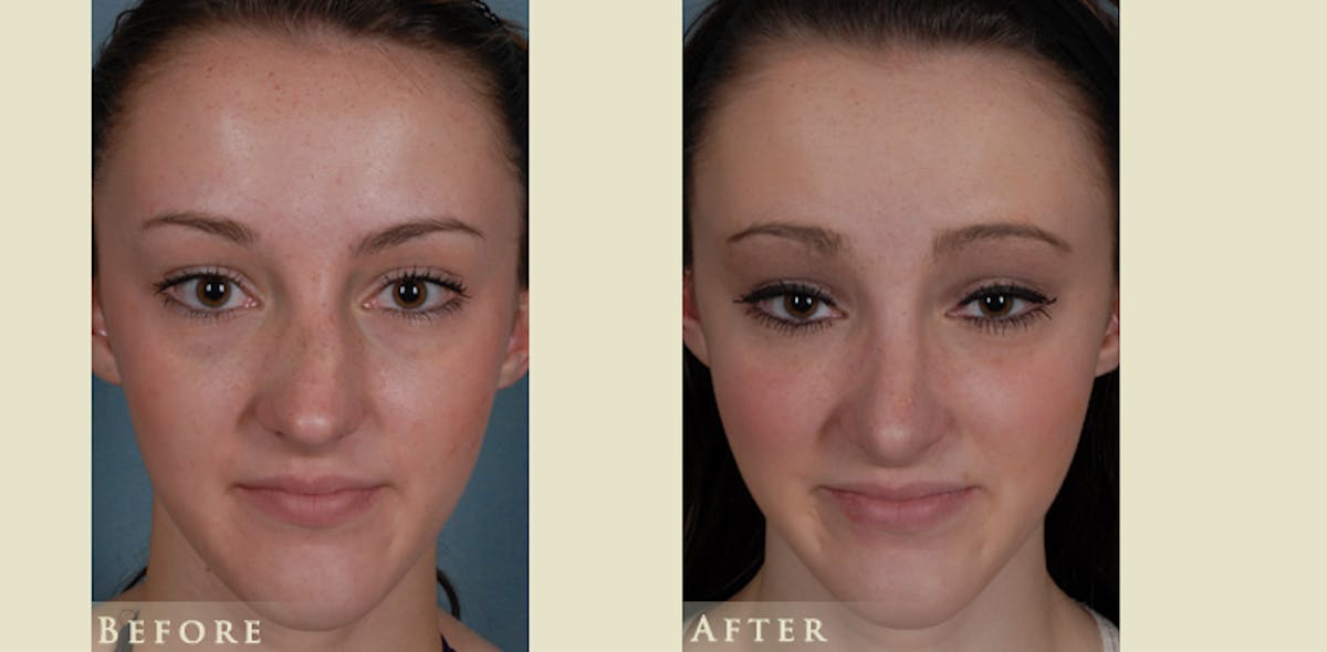 Reconstructive Rhinoplasty Before & After Gallery - Patient 273940 - Image 1