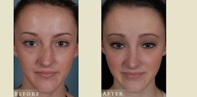 Reconstructive Rhinoplasty Before & After Gallery - Patient 273940 - Image 1