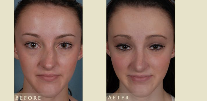 Reconstructive Rhinoplasty Before & After Gallery - Patient 273940 - Image 1