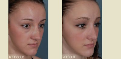 Reconstructive Rhinoplasty Before & After Gallery - Patient 273940 - Image 2