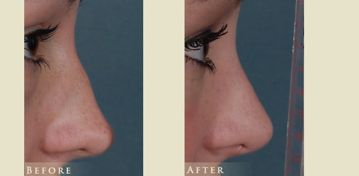 Reconstructive Rhinoplasty Before & After Gallery - Patient 273940 - Image 3
