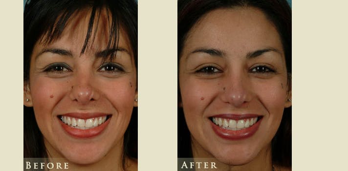 Reconstructive Rhinoplasty Before & After Gallery - Patient 132364 - Image 1