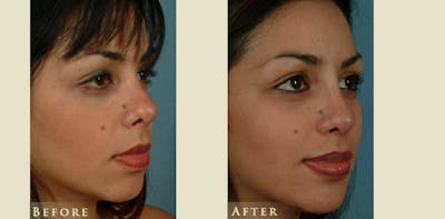 Reconstructive Rhinoplasty Before & After Gallery - Patient 132364 - Image 2