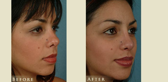 Reconstructive Rhinoplasty Before & After Gallery - Patient 132364 - Image 2