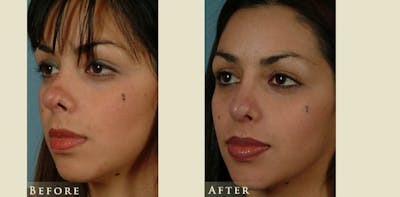 Reconstructive Rhinoplasty Before & After Gallery - Patient 132364 - Image 3