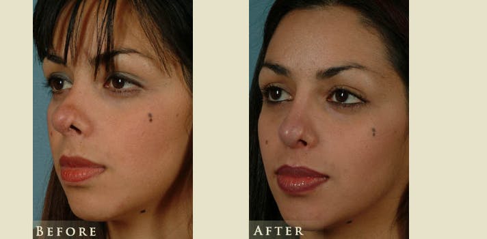 Reconstructive Rhinoplasty Before & After Gallery - Patient 132364 - Image 3