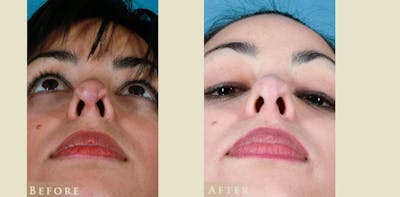 Reconstructive Rhinoplasty Before & After Gallery - Patient 132364 - Image 4