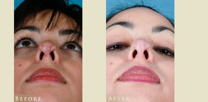 Reconstructive Rhinoplasty Before & After Gallery - Patient 132364 - Image 4