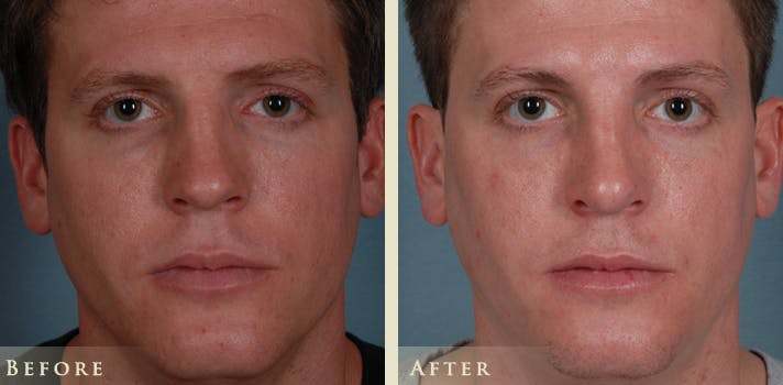 Reconstructive Rhinoplasty Before & After Gallery - Patient 180489 - Image 1