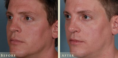Reconstructive Rhinoplasty Before & After Gallery - Patient 180489 - Image 2